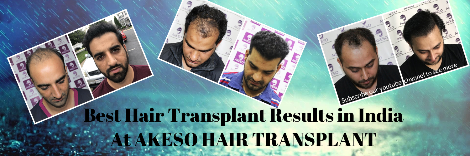 Best Hair Transplant Results Delhi, India | Akeso Hair Transplant