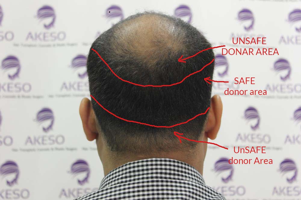 Safe Donor Zone for Hair Transplant | Akeso Hair Transplant India