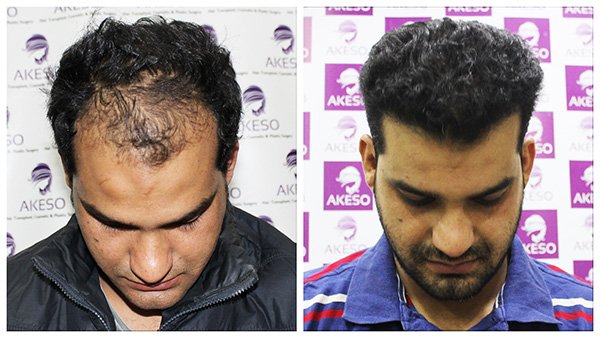 Best Hair Transplant In India At Akeso Clinic Delhi Gurgaon best hair transplant in india at akeso