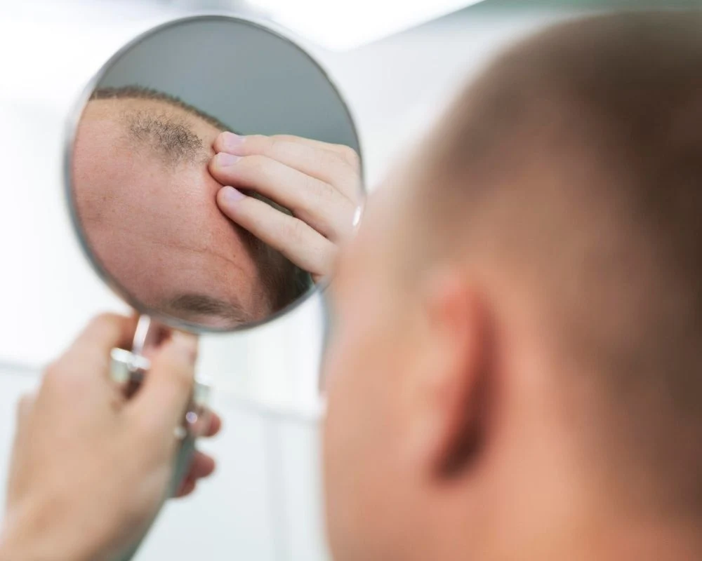 Result after hair transplant