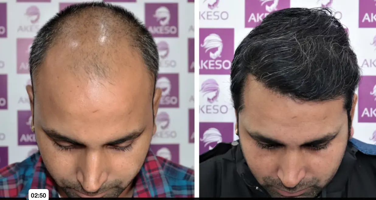 before and after hair transplant