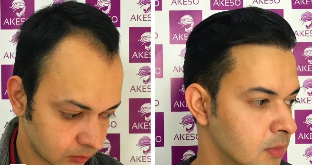 before and after hair transplant